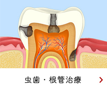 虫歯・根管治療