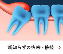 親知らずの抜歯・移植