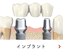 インプラント