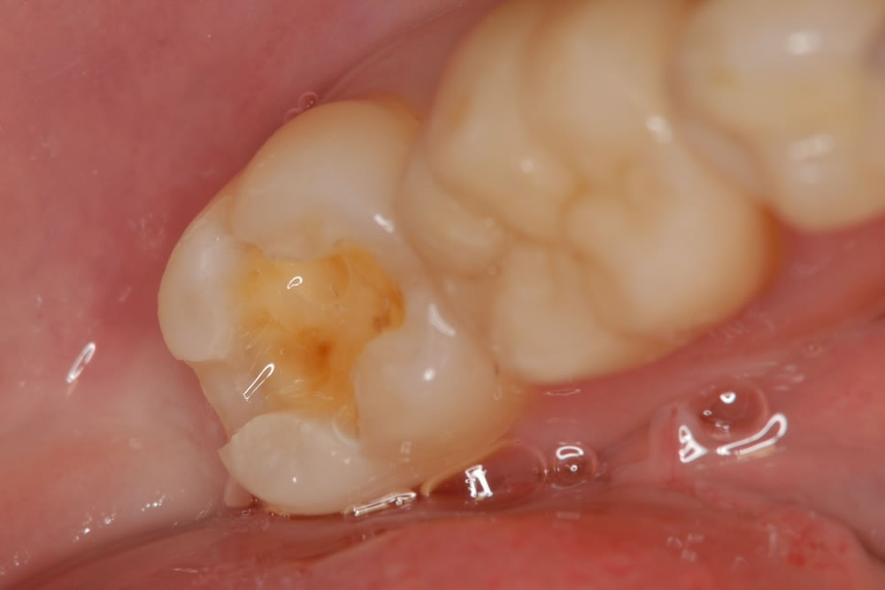 銀歯の除去・土台の形成