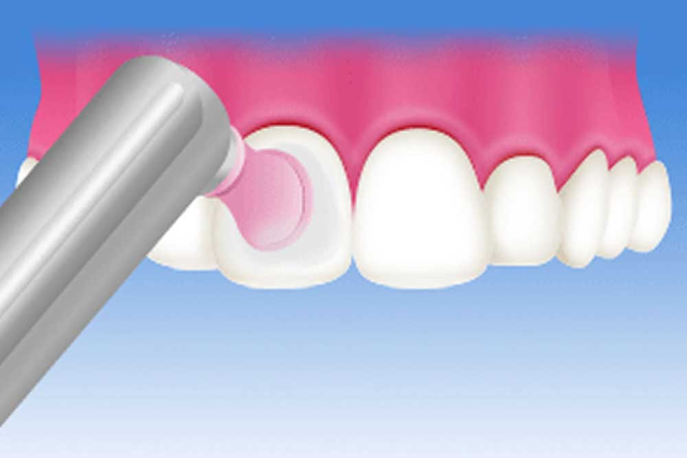 歯のクリーニング（PMTC)