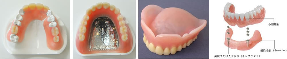 入れ歯の素材や形状