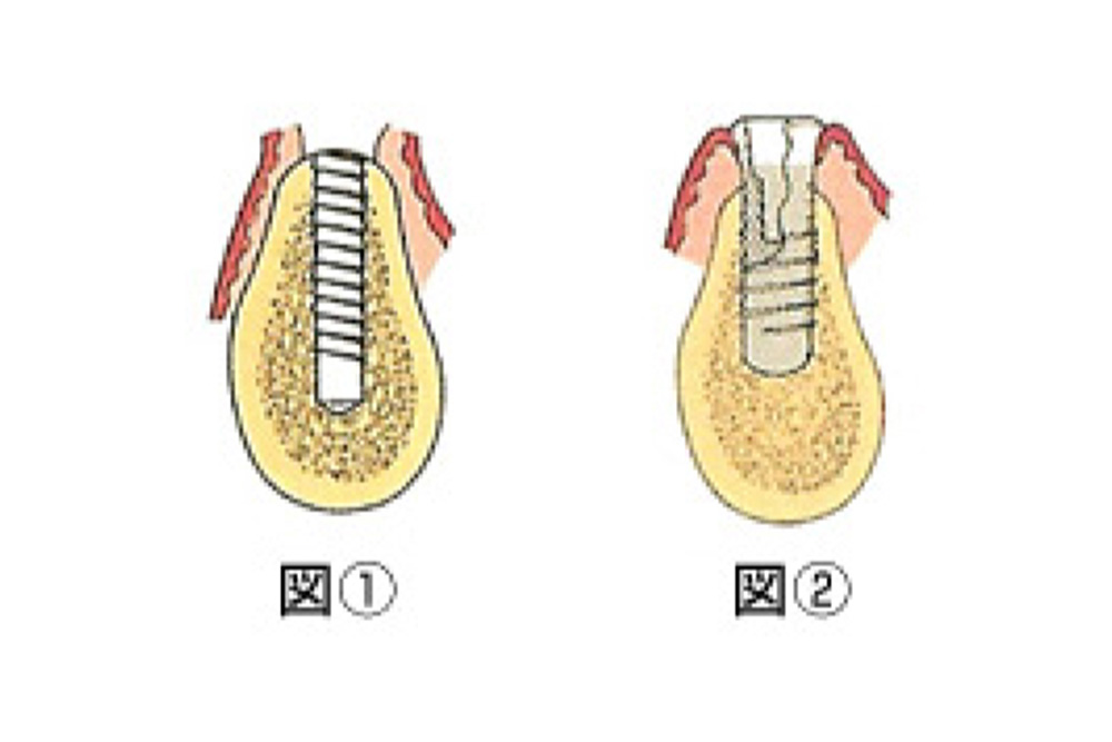インプラント体埋込手術