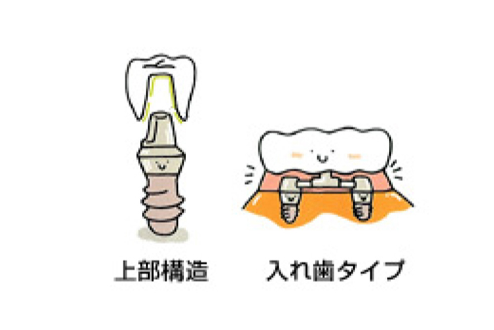 上部構造（歯）の装着