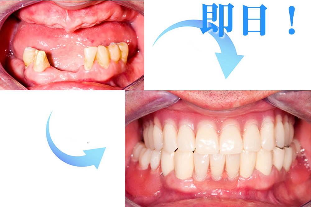 即日インプラント
