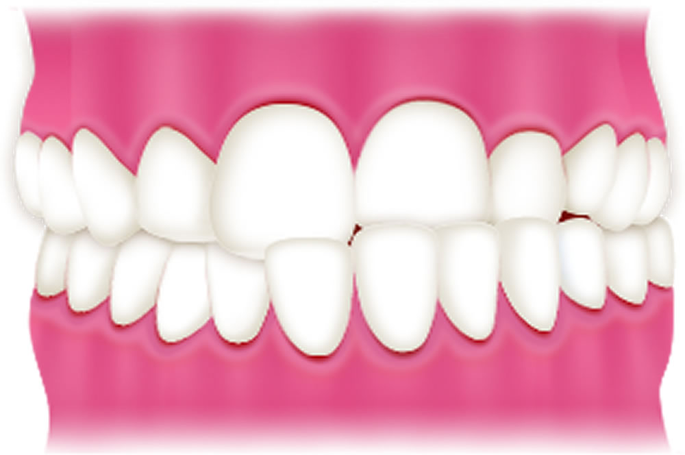 八重歯・叢生