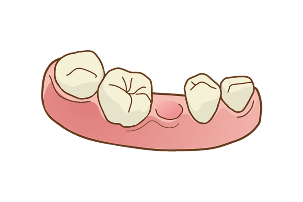 臼歯部の欠損