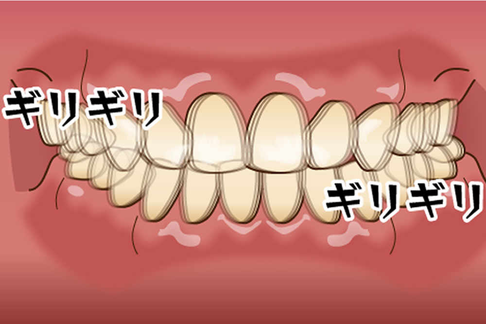 過度な食いしばりや歯ぎしり